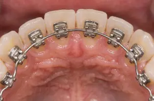 Lingual braces